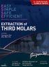 Extraction of third molars(사랑니발치영문판)